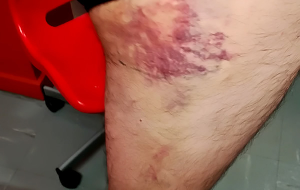 Πολυχρονίδης τραυματισμός